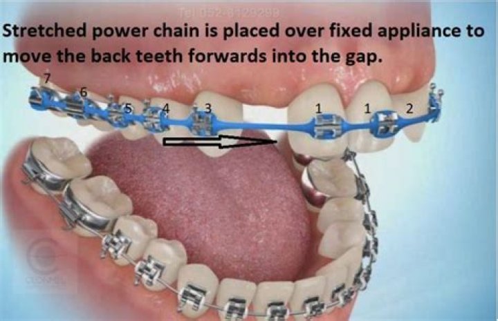 How long do power chains take to close gaps